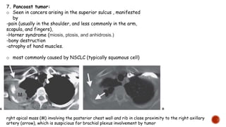 7. Pancoast tumor:
o Seen in cancers arising in the superior sulcus , manifested
by
-pain (usually in the shoulder, and less commonly in the arm,
scapula, and fingers),
-Horner syndrome (miosis, ptosis, and anhidrosis.)
-bony destruction
-atrophy of hand muscles.
o most commonly caused by NSCLC (typically squamous cell)
rght apical mass (M) involving the posterior chest wall and rib in close proximity to the right axillary
artery (arrow), which is suspicious for brachial plexus involvement by tumor
 