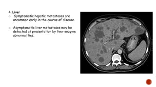 4. Liver
o Symptomatic hepatic metastases are
uncommon early in the course of disease.
o Asymptomatic liver metastases may be
detected at presentation by liver enzyme
abnormalities.
 