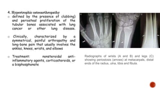 4. Hypertrophic osteoarthropathy
o defined by the presence of clubbing)
and periosteal proliferation of the
tubular bones associated with lung
cancer or other lung disease.
o Clinically, characterized by a
symmetrical, painful arthropathy and
long-bone pain that usually involves the
ankles, knees, wrists, and elbows
o Treatment: nonsteroidal anti-
inflammatory agents, corticosteroids, or
a bisphosphonate
Radiographs of wrists (A and B) and legs (C)
showing periostosis (arrows) at metacarpals, distal
ends of the radius, ulna, tibia and fibula.
 