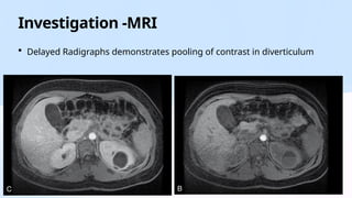Contrast Pooling CALYCEAL DIVERTICULUM- THE UNEXPECTED GUEST IN THE KIDNEY.pptx