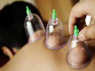  one of the oldest and most effective methods of releasing
toxins from the body’s tissues and organs.
 Cupping is a safe, non-invasive and inexpensive technique.
 It is used to alleviate the pain arising from internal organs,
muscle spasms, joint pains, and numerous other conditions.
 The ancient Egyptians were the first to use cupping therapy
* Cupping in the Middle East and the Muslim World
 known as ‘Hajama’ which means ‘to restore to basic
size’ or ‘to diminish in volume’.
 The Prophet Muhammed -PBUH -is reported to have been a
user and advocate of cupping therapy.
Cupping (hijamah)
 