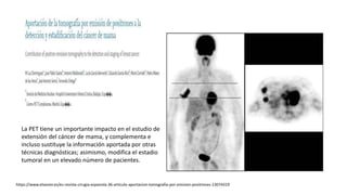 La PET tiene un importante impacto en el estudio de
extensión del cáncer de mama, y complementa e
incluso sustituye la información aportada por otras
técnicas diagnósticas; asimismo, modifica el estadio
tumoral en un elevado número de pacientes.
https://www.elsevier.es/es-revista-cirugia-espanola-36-articulo-aportacion-tomografia-por-emision-positrones-13074319
 