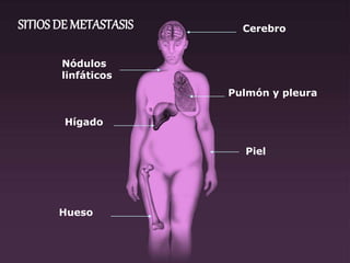 SITIOS DE METASTASIS Cerebro
Pulmón y pleura
Hueso
Hígado
Nódulos
linfáticos
Piel
 