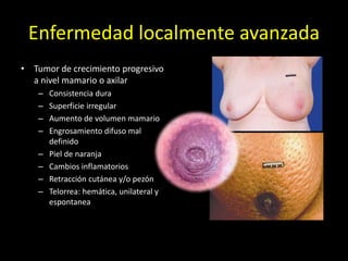 Enfermedad localmente avanzada
• Tumor de crecimiento progresivo
a nivel mamario o axilar
– Consistencia dura
– Superficie irregular
– Aumento de volumen mamario
– Engrosamiento difuso mal
definido
– Piel de naranja
– Cambios inflamatorios
– Retracción cutánea y/o pezón
– Telorrea: hemática, unilateral y
espontanea
 