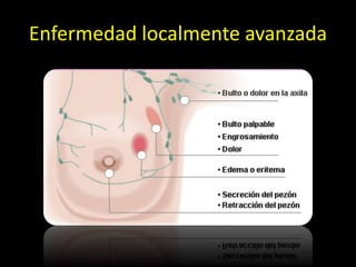 Enfermedad localmente avanzada
 