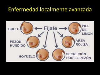 Enfermedad localmente avanzada
 