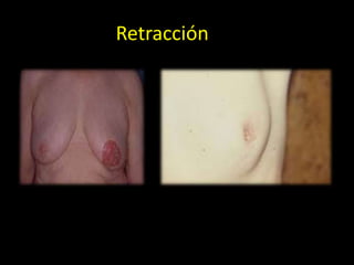 Retracción
 