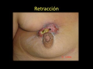 Retracción
 