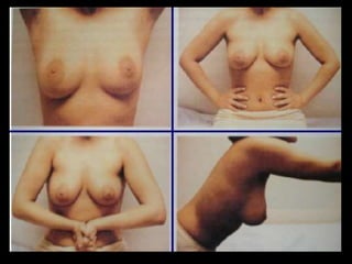 Examen clínico de las mamas
 