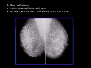 2.- Micro calcificaciones
• Pueden presentar diferentes morfologías
• Numerosas, en líneas finas o ramificadas son las más preocupantes
 