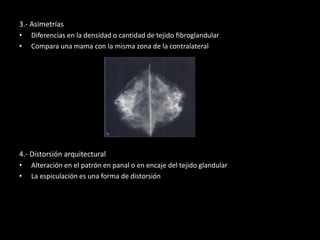 3.- Asimetrías
• Diferencias en la densidad o cantidad de tejido fibroglandular
• Compara una mama con la misma zona de la contralateral
4.- Distorsión arquitectural
• Alteración en el patrón en panal o en encaje del tejido glandular
• La espiculación es una forma de distorsión
 