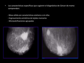 • Las características específicas que sugieren el diagnóstico de Cáncer de mama
comprenden:
- Masa sólida con características estelares o sin ellas
- Engrosamiento asimétrico de tejidos mamarios
- Microcalcificaciones agrupadas
 