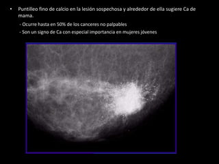 • Puntilleo fino de calcio en la lesión sospechosa y alrededor de ella sugiere Ca de
mama.
- Ocurre hasta en 50% de los canceres no palpables
- Son un signo de Ca con especial importancia en mujeres jóvenes
 