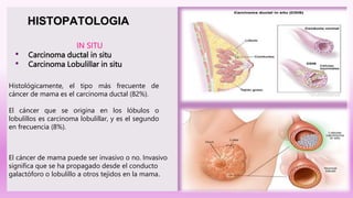 IN SITU
• Carcinoma ductal in situ
• Carcinoma Lobulillar in situ
HISTOPATOLOGIA
Histológicamente, el tipo más frecuente de
cáncer de mama es el carcinoma ductal (82%).
El cáncer que se origina en los lóbulos o
lobulillos es carcinoma lobulillar, y es el segundo
en frecuencia (8%).
El cáncer de mama puede ser invasivo o no. Invasivo
significa que se ha propagado desde el conducto
galactóforo o lobulillo a otros tejidos en la mama.
 
