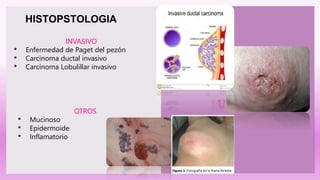 INVASIVO
• Enfermedad de Paget del pezón
• Carcinoma ductal invasivo
• Carcinoma Lobulillar invasivo
HISTOPSTOLOGIA
OTROS
• Mucinoso
• Epidermoide
• Inflamatorio
 