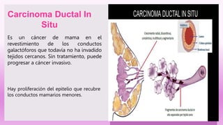 Es un cáncer de mama en el
revestimiento de los conductos
galactóforos que todavía no ha invadido
tejidos cercanos. Sin tratamiento, puede
progresar a cáncer invasivo.
Carcinoma Ductal In
Situ
Hay proliferación del epitelio que recubre
los conductos mamarios menores.
 