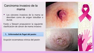  Los cánceres invasivos de la mama se
describen como de origen lobulillar o
ductal.
Carcinoma invasivo de la
mama
Foote y Stewart propusieron la siguiente
clasificación de cáncer de mama invasivo:
1. Enfermedad de Paget del pezón:
Erupción eccematosa crónica del pezón
 