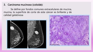 3. Carcinoma mucinoso (coloide):
Se define por fondos comunes extracelulares de mucina,
mucina, la superficie de corte de este cáncer es brillante y de
calidad gelatinosa
 