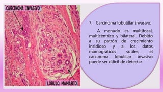 7. Carcinoma lobulillar invasivo:
A menudo es multifocal,
multicéntrico y bilateral. Debido
a su patrón de crecimiento
insidioso y a los datos
mamográficos sutiles, el
carcinoma lobulillar invasivo
puede ser difícil de detectar
 