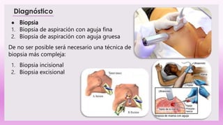 ● Biopsia
1. Biopsia de aspiración con aguja fina
2. Biopsia de aspiración con aguja gruesa
De no ser posible será necesario una técnica de
biopsia más compleja:
1. Biopsia incisional
2. Biopsia excisional
 