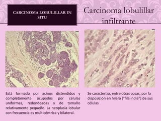 la PET, por medio del radiofármaco fl uor-estradiol (18F-ES), ofrece la posibilidad de estudiar la presencia de receptores estrogénicos tanto en tumor primario como en sus metástasis, pudiendo ser una herramienta muy útil en el manejo terapéutico y en la valoración pronóstica del cáncer de mama. distancia.El compuesto más usado para PET es la 2-F18-Fluor-deoxi-glucosa