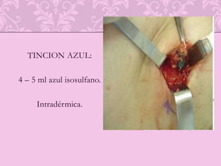  En este sentido, lo ideal es que la lesión no diste más de 10mm del arpón. Interpretación y valor de las microcalcificaciones