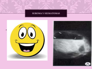 Tumorectomía. Segmentectomía ó Mastectomía segmentaria.Cuadrantectomía. Mastectomía radical modificada. 