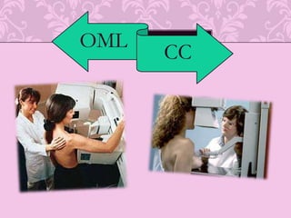 Intensificación del sistema inmune contra ca. De mama