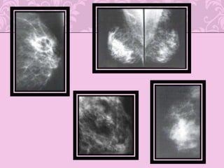 Se limita a superficie apical de células epiteliales 