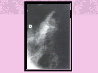 Posible molécula blanco de la inmunoterapia especifica activa 