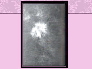 Mutaciones somáticas de RAS causan gran respuesta de los linfocitos cito toxico