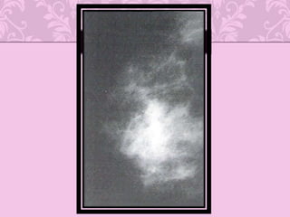 Mutación de p53 causa producción de anticuerpos en ca de mama en 20 % 