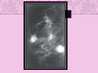 Marcador utilizado con mayor frecuencia en el estudio de cáncer de mama 