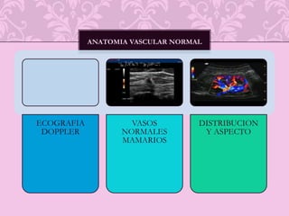 Signos mastográficos del cáncer