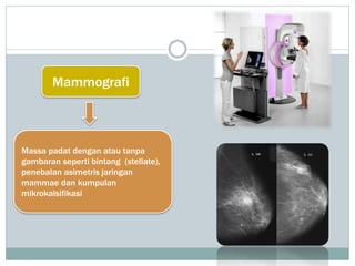 Mammografi
Massa padat dengan atau tanpa
gambaran seperti bintang (stellate),
penebalan asimetris jaringan
mammae dan kumpulan
mikrokalsifikasi
 