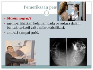 Pemeriksaan penunjang
 Mammografi
• memperlihatkan kelainan pada payudara dalam
bentuk terkecil yaitu mikrokalsifikasi.
• akurasi sampai 90%.
 