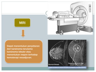 MRI
Dapat menentukan penyebaran
dari karsinoma terutama
karsinoma lobuler atau
menentukan respon terhadap
kemoterapi neoadjuvan.
 