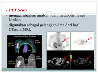  PET Scan
• menggambarkan anatomi dan metabolisme sel
kanker.
• digunakan sebagai pelengkap data dari hasil
CTscan, MRI.
 