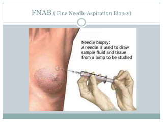 FNAB ( Fine Needle Aspiration Biopsy)
 