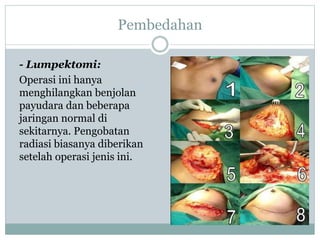 Pembedahan
- Lumpektomi:
Operasi ini hanya
menghilangkan benjolan
payudara dan beberapa
jaringan normal di
sekitarnya. Pengobatan
radiasi biasanya diberikan
setelah operasi jenis ini.
 