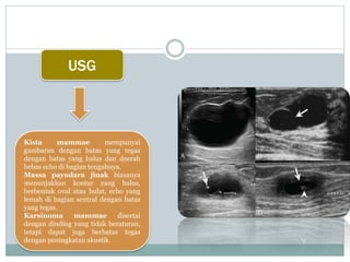 USG
Kista mammae mempunyai
gambaran dengan batas yang tegas
dengan batas yang halus dan daerah
bebas echo di bagian tengahnya.
Massa payudara jinak biasanya
menunjukkan kontur yang halus,
berbentuk oval atau bulat, echo yang
lemah di bagian sentral dengan batas
yang tegas.
Karsinoma mammae disertai
dengan dinding yang tidak beraturan,
tetapi dapat juga berbatas tegas
dengan peningkatan akustik.
 