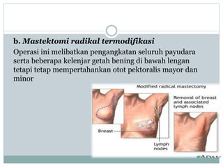 b. Mastektomi radikal termodifikasi
Operasi ini melibatkan pengangkatan seluruh payudara
serta beberapa kelenjar getah bening di bawah lengan
tetapi tetap mempertahankan otot pektoralis mayor dan
minor
 