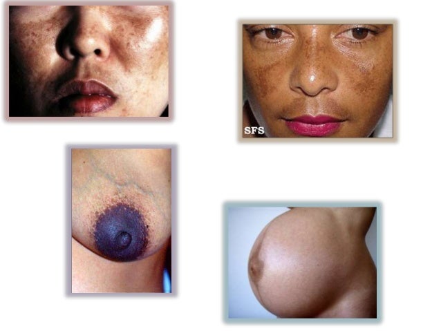 Las manchas blancas de pigmento por