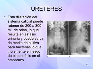 8
URETERES
• Esta dilatación del
sistema calicial puede
retener de 200 a 300
mL de orina, lo que
resulta en estasis
urinar...