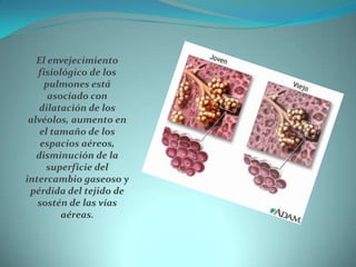 El envejecimiento fisiológico de los pulmones está asociado con dilatación de los alvéolos, aumento en el tamaño de los es...