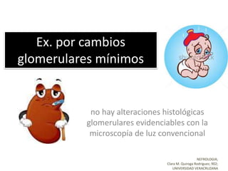 Ex. por cambios
glomerulares mínimos
no hay alteraciones histológicas
glomerulares evidenciables con la
microscopía de luz convencional
NEFROLOGIA;
Clara M. Quiroga Rodríguez; 902;
UNIVERSIDAD VERACRUZANA
 