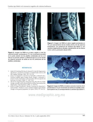 Modic Columna Cambiosmodic | PDF
