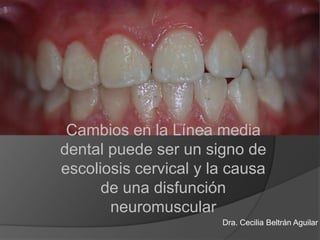 Cambios en la Línea media dental puede ser un signo de escoliosis cervical y la causa de una disfunción neuromuscular  Dra. Cecilia Beltrán Aguilar 