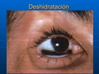 Deshidratación
 