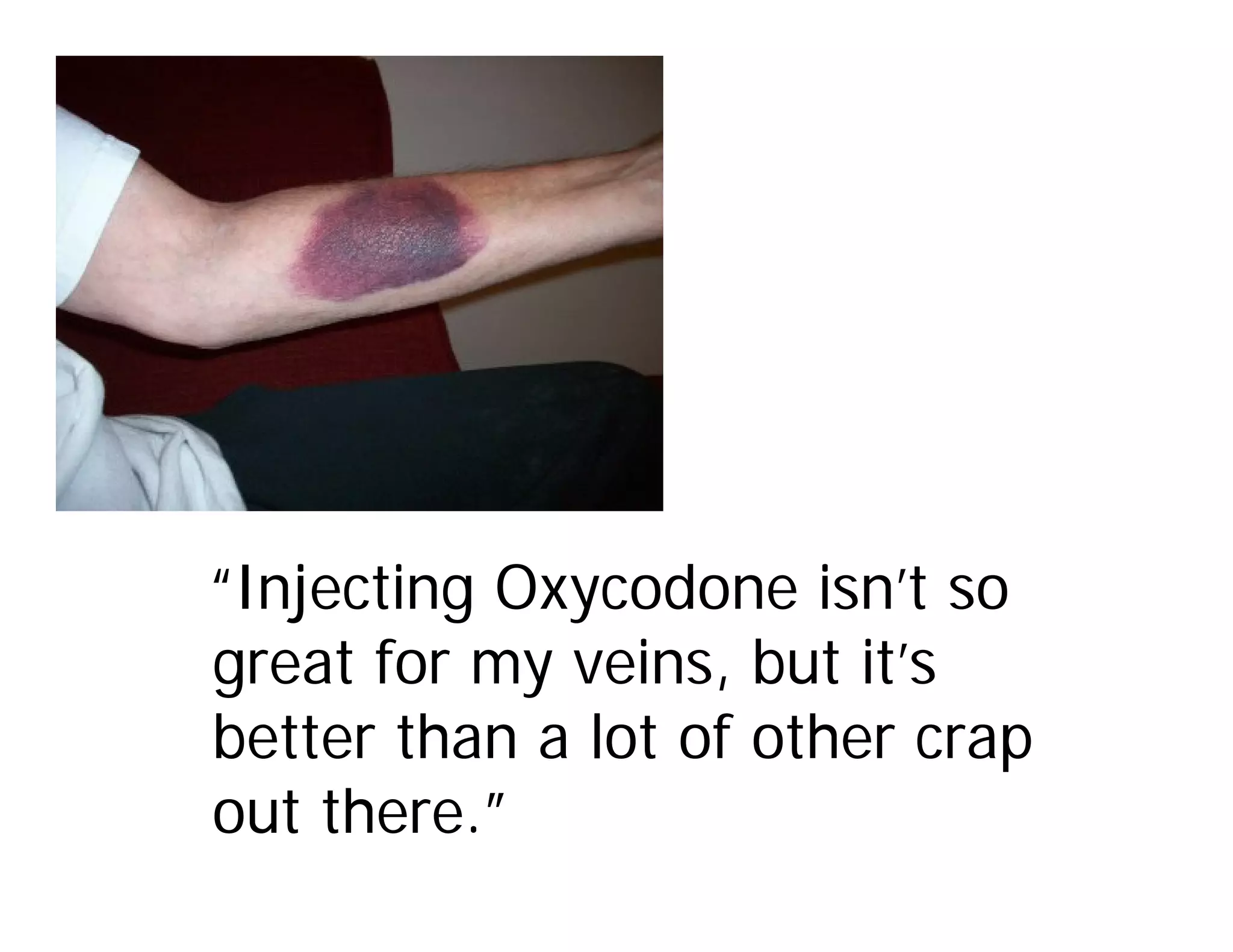 “Injecting Oxycodone isn’t so
great for my veins, but it’s
better than a lot of other crap
out there.”
 